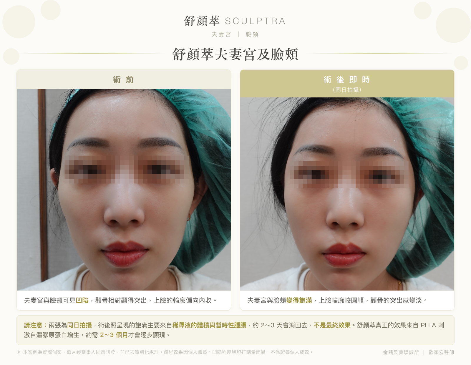 舒顏萃夫妻宮及臉頰術前與術後即時對比:術前夫妻宮與臉頰凹陷,術後即時變得飽滿(同日拍攝,飽滿主要來自稀釋液)